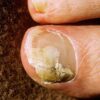 Toenail fungus