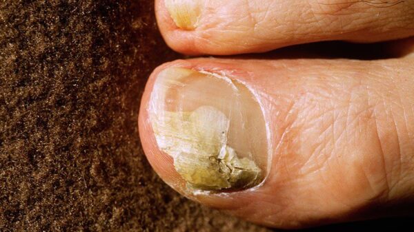 Toenail fungus